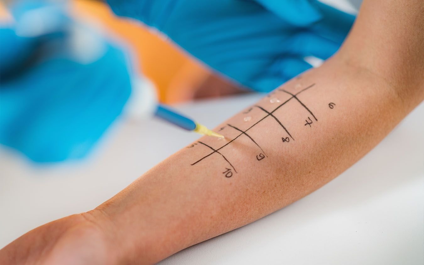 Prueba para detectar alergias